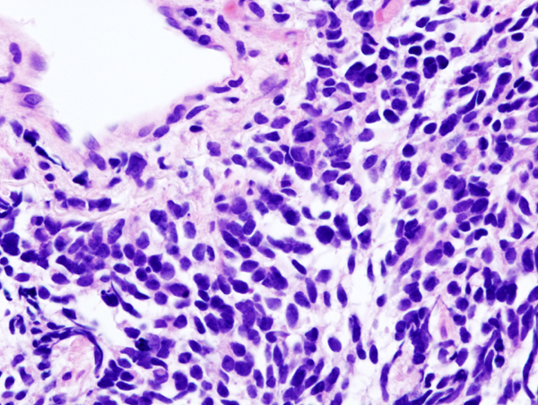 CT-Guided Needle Biopsy